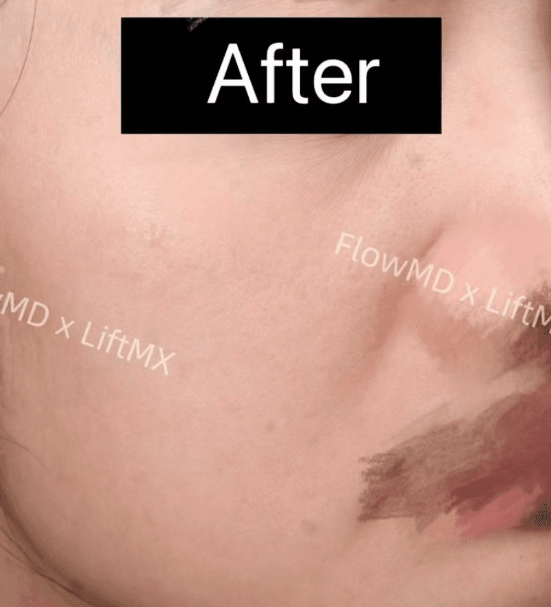 Skin Rejuvenation - After