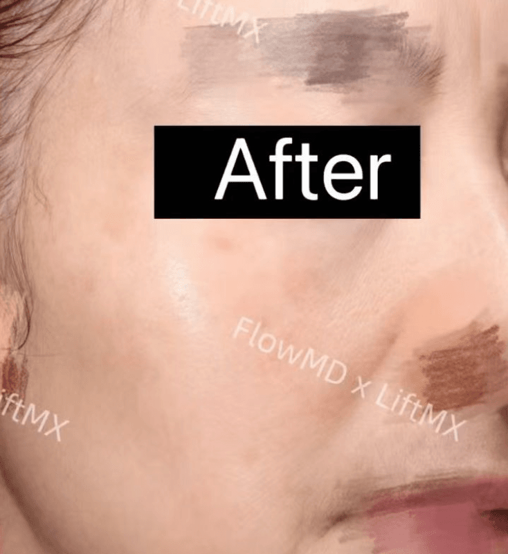 Fine Line Reduction - After