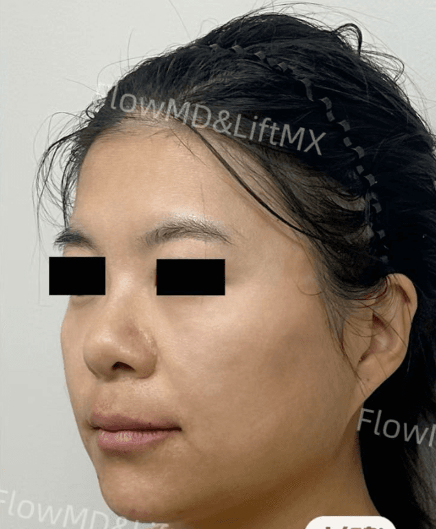 Facial Contouring - After
