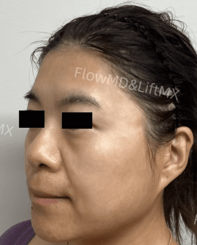 Facial Contouring - Before