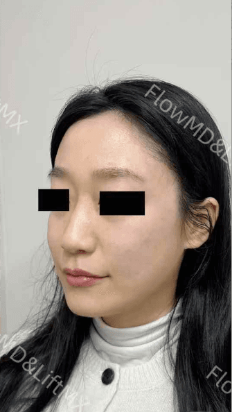 Pigmentation Correction - After