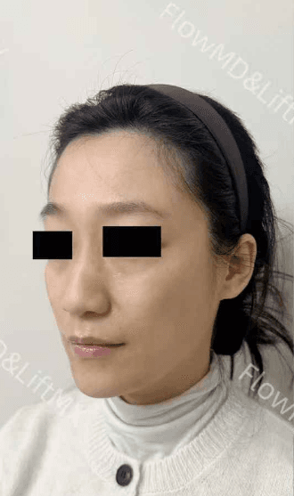 Pigmentation Correction - Before