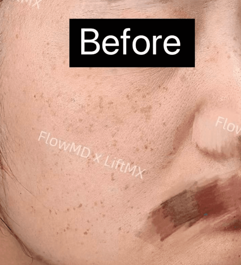 Skin Rejuvenation - Before