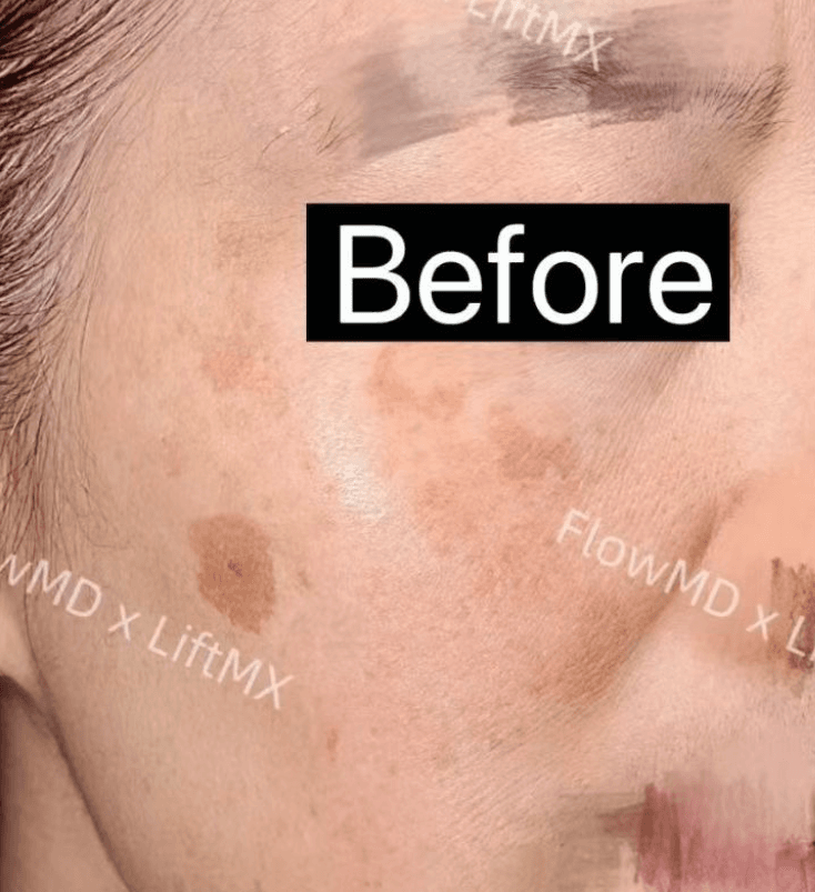 Fine Line Reduction - Before